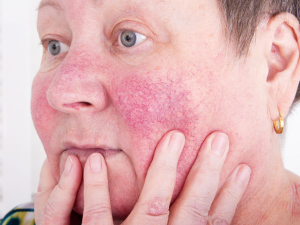 Parapharmacie vente en ligne de produits Dermite Séborrhéïque Visage Parapharmacie vente en ligne de produits Dermite Séborrhéïque Visage