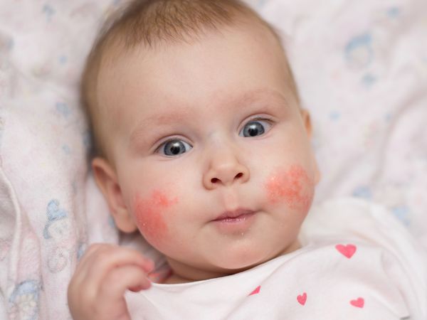 dermatite bebe visage hpv pode dar cancer de mama